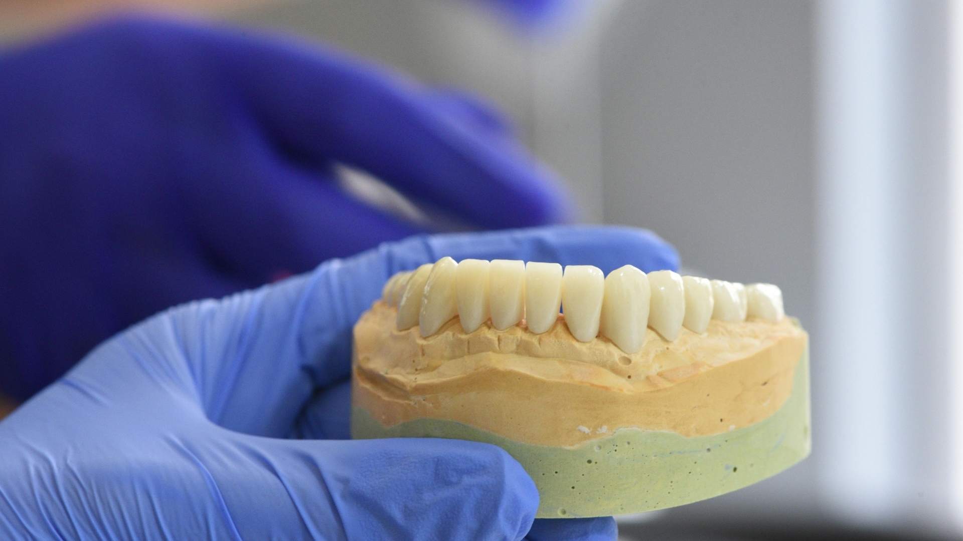 Implantációs fogpótlás a MyDent fogászat Margit körúti rendelőjében